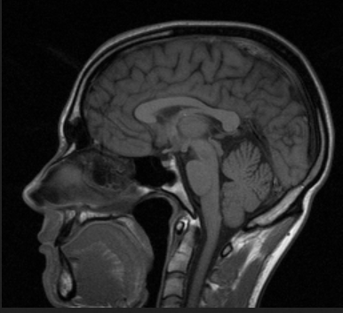 MRI scan of a human head in profile, sagittal view